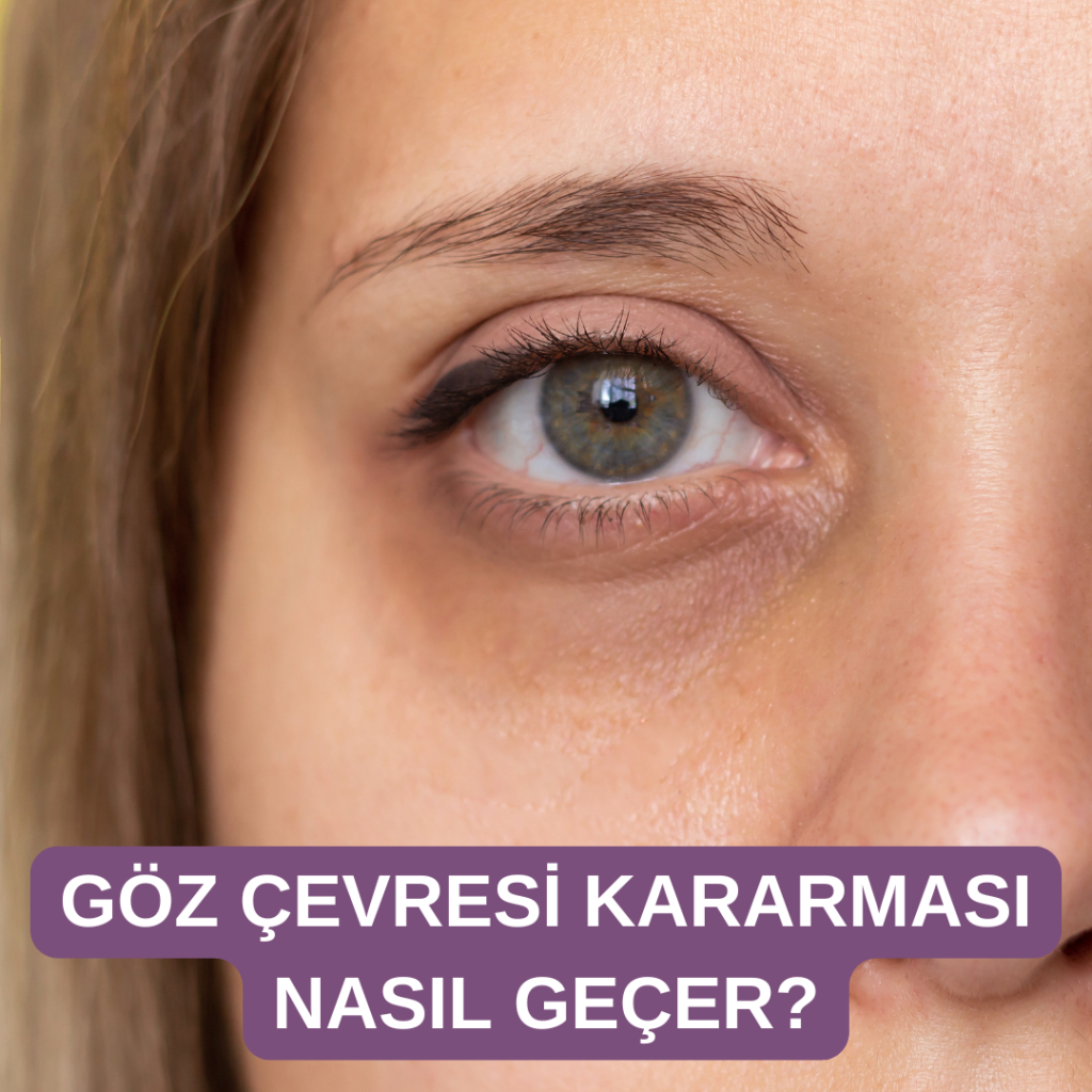 göz çevresi kararması nasıl geçer