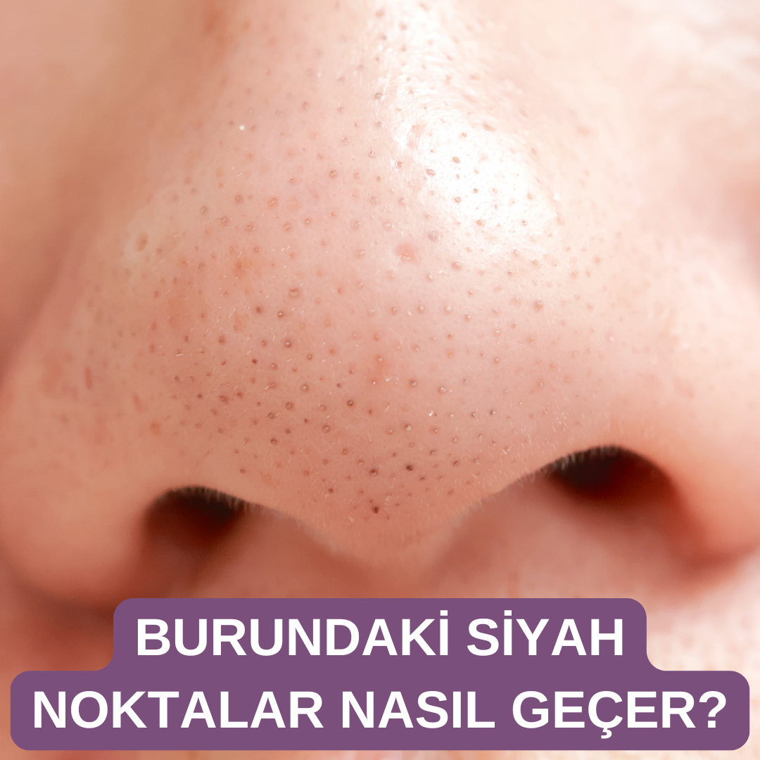 Burun Siyah Nokta Nasıl Geçer?