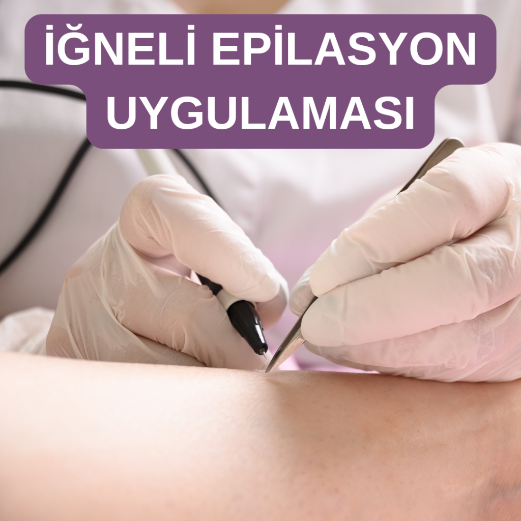 iğneli epilasyon nasıl yapılır